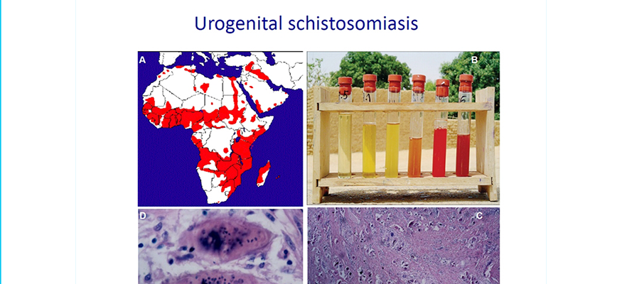 Urogenital Schistosomiasis Diagram